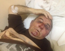 Dhunimi i 54-vjeçarit në Kuçovë<br />shoqërohet një i dyshua