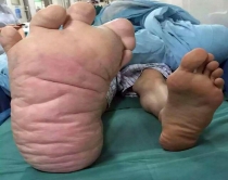 Kin&euml;, djali vuan nga gjigandizmi<br />K&euml;mba 50 cm vazhdon t&euml; rritet