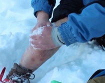 Dëmton këmbën në majë të malit<br />e operon vetë në mes të dëborës