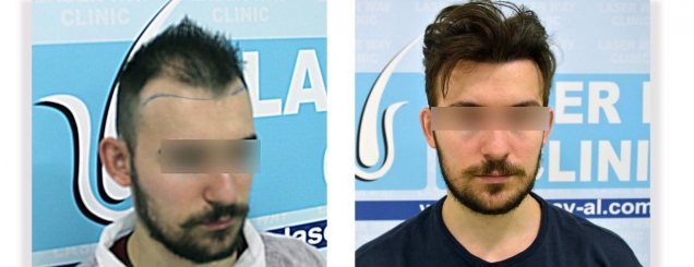 Mbjellja e flokut,teknologjia më e re<br />tani në Shqipëri te 'Laser Way Clinic'
