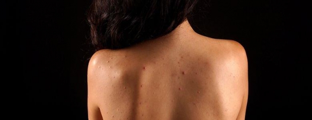 ​Akne në shpinë? Dermatologu i<br />Kendall Jenner tregon si ti heqim