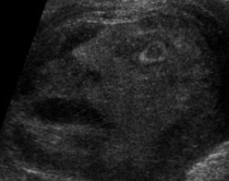 Tumori testikular<br />ekografia shfaq një fytyrë