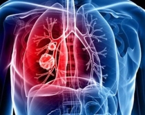 OBSH: Ndotja e ajrit shkakton<br />kancer të mushkërive