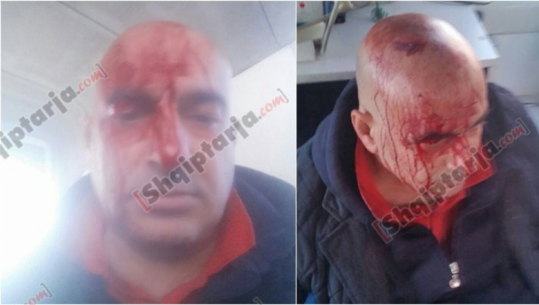  Vlorë, goditet me levë në kokë, biznesmeni akuzon prokurorin: Ai fshihet pas ngjarjes