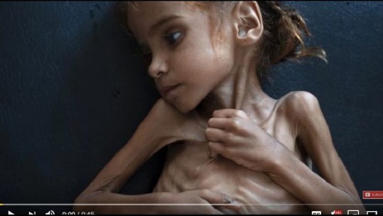  U bë simbol i krizës humanitare botë, vogëlushja Amal nuk jeton më