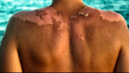 Dermatologia: Ruhuni nga dielli gjatë verës! Djegiet e rënda kthehen në kancer të lëkurës
