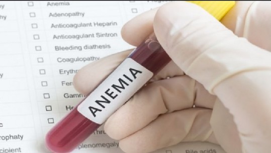 Anemia, shkaqet e simptomat, rëndësia e diagnozës laboratorike