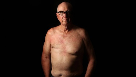 Kanceri i gjirit prek edhe burrat (FOTO)