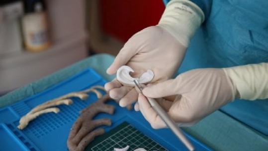 Itali, rindërtohet veshi i një fëmije falë stampimit 3D, që pati për model veshin e nënës së tij