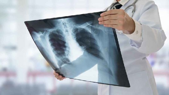 Rriten rastet e Tuberkulozit? OBSH: Nuk ka përkeqësim të shifrave në Shqipëri