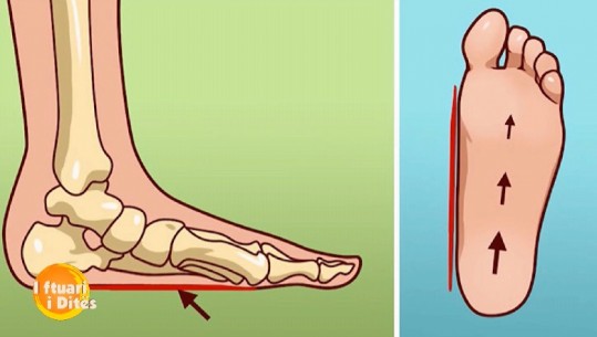 Këmbët e sheshta, ja problemet që i sjellin trupit të njeriut (VIDEO)