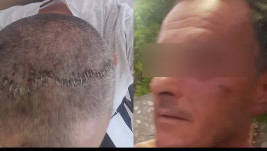‘Pashë një hije dhe më pas u zgjova i mbuluar në gjak’, rrëfehet polici grek i cili u rrah brutalisht nga 50-vjeçari shqiptar: Kishte qëllim të më vriste 