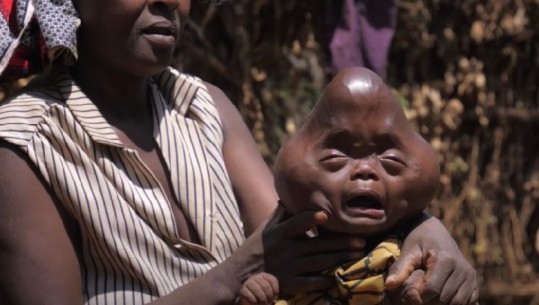 Afrikë, djali lind me sindromën deformuese në kokë, babai e braktis: 'Biri i djallit'