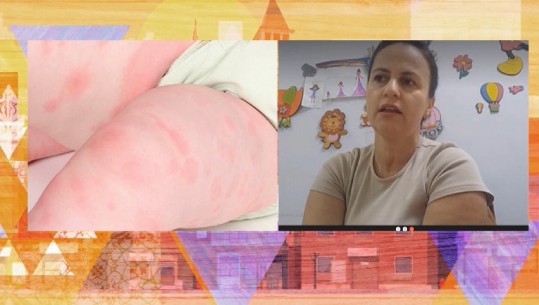  Sëmundja 'duar-këmbë-gojë' po përhapet në çerdhe e kopshte, pediatrja Sonila Biba në Report Tv: Kujdes! Fëmijët e prekur të izolohen, thelbësore higjena  