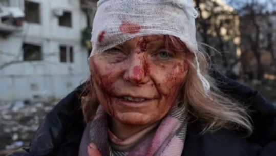 Fotogaleri/ Njerëz të gjakosur dhe tym e flakë, pamje të trishta nga Ukraina pas sulmeve ruse