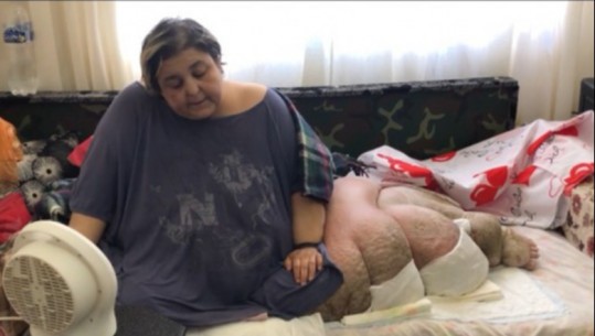 Apeloi për ndihmë në Report Tv, por nuk iu sigurua mjekim jashtë shtetit! Ndërron jetë 38-vjeçarja nga Vlora, Blerina Rapushi! Vuante nga sëmundja e elefantizmit dhe peshonte 460 kg