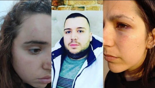 VIDEO/ Goditi dy vajza me grushte në Tiranë, arrestohet 30-vjeçari me probleme të shëndetit mendor! E reja e dhunuar për Report Tv: Kam dëmtime në kokë e sy! Shoqëria civile protestë: Rast i përsëritur