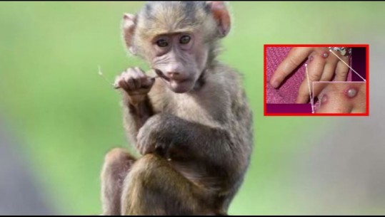 Lija e majmunit/ Si transmetohet tek njerëzit, çfarë shenjash shfaqen dhe sa zgjasin simptomat 