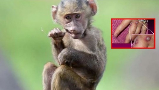 OBSH: S’do e quajmë me ‘lija e majmunit’, është raciste! Kur s’është figura e majmunit, njerëzit e marrin më seriozisht sëmundjen
