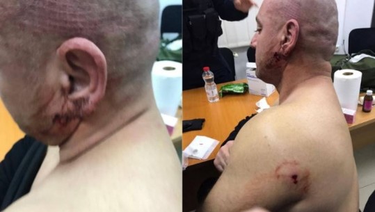 Tensionet në veri të Kosovës, Sveçla publikon foton e efektivit të plagosur: Propaganda e Vuçiç, s’bind askënd! Polici u sulmua nga grupet e tij kriminale