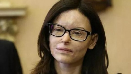 Lirohet pas 9 vitesh burg shqiptari që sulmoi me acid në fytyrë avokaten italiane! Lucia Annibali: Tani nuk kam më frikë, ai është në Shqipëri