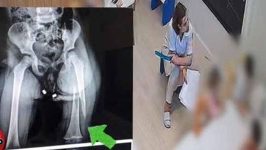 Dhuna te kopshti ‘Stinët’, edukatorja: S’e preka vajzën, 3-vjeçarja dëmtoi vetë këmbën tek hapësirat e krevatit