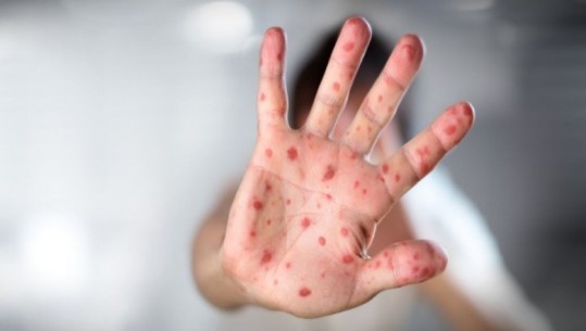 Rriten rastet me fruth në Shqipëri, ISHP konfirmon 17 të infektuar