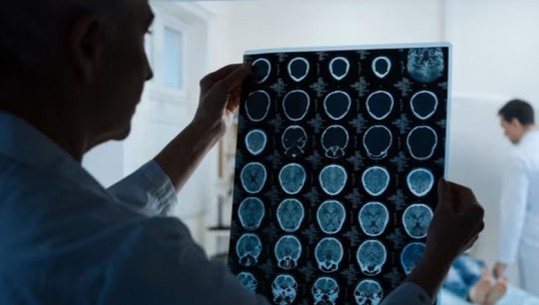 Ekspertët: Testi i parë i gjakut në botë për tumorin e trurit, rrit shanset për mbijetesë