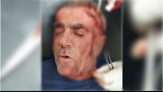 FOTO/ U godit me zinxhir në kokë nga një person i maskuar, efektivi i burgut të Fierit i plagosur në spital