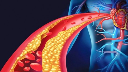 Nivelet e kolesterolit ulen në verë dhe rriten në dimër, kujdesi që ju duhet