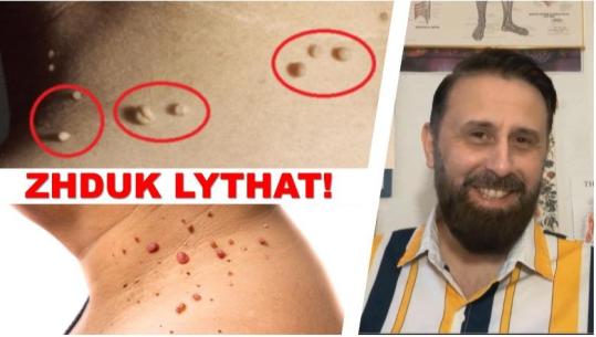  Lythat, kërcënim i heshtur i trupit / Shkaku i vërtetë dhe receta si t’i zhdukësh përgjithmonë