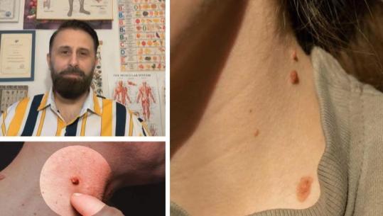 Keni lytha në qafë, mbi qepalla apo në trup? Organizmi juaj po ‘thërret’, ja si duhet të veproni! 