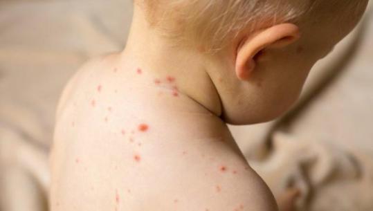 Konfirmohet rasti i parë i fruthit në Shqipëri, fëmija i prekur është i pavaksinuar