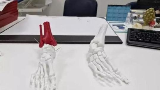 Historia e Besjanës, si arriti të ecë 27- vjeçarja shqiptare pas 10 vitesh operacione në Itali