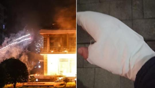 Aktet e dhunës nga militantët e Berishës, fotoreporteri Malton Dibra përfundon në spital! I ra në duar molotovi që u hodh drejt vilës së Enver Hoxhës