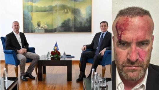 Kreu i Vetëvendosjes në Skënderaj të Kosovës, akuzon kryetarin e komunës për dhunë : Policia të mbrojë familjen time! Vetëvendosja publikon foton e përgjakur