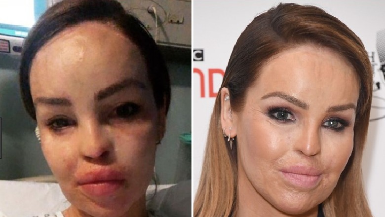 U sulmua nga ish i dashuri me acid! Gazetarja i nënshtrohet operacionit të 250-të, gjërat përkeqësohen për të (FOTO)