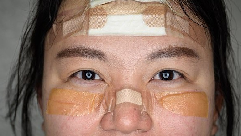Mjekët dhe infermierët zbulojnë shenjat e plagët që i shkakton maska e koronavirusit (FOTO)
