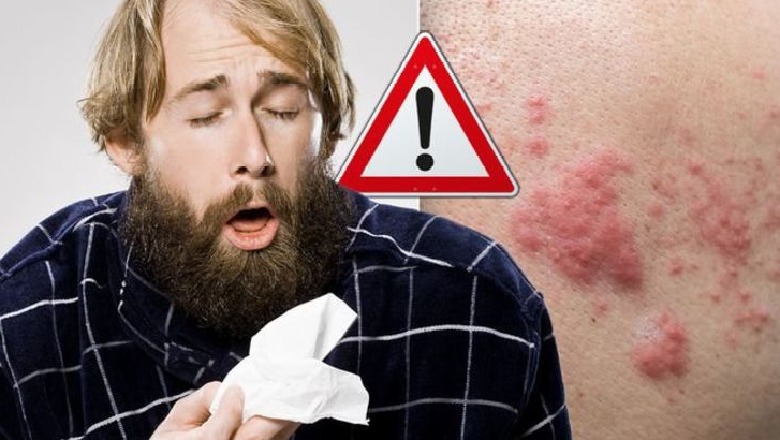 Simptomat e koronavirusit/ Shenja e re COVID-19 në lëkurën tuaj....I keni këto pika të kuqe?