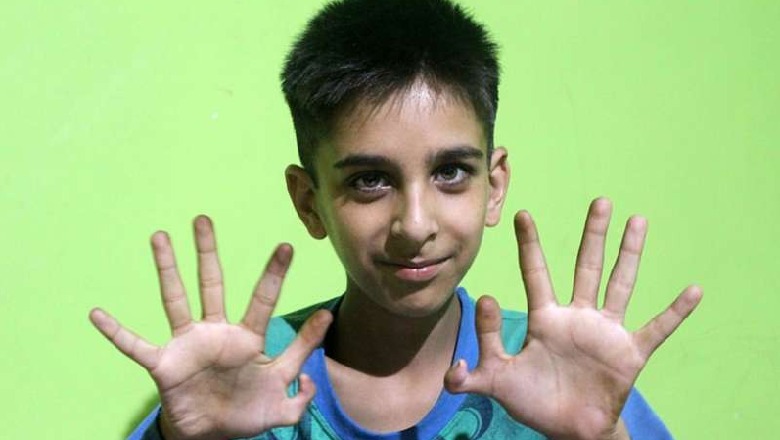 12 vjeçari indian që ka lindur me 12 gishta: Luaj më mirë me video lojëra