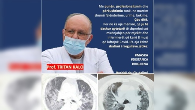 Mjeku Kalo publikon imazhe të mushkërive të dëmtuara nga të rinj që kanë humbur jetën: COVID-19 nuk njeh moshë