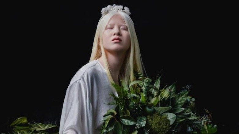 U konsiderua një ‘mallkim’, modelja albine e ‘Vogue’ mahnit me bukurinë e saj 