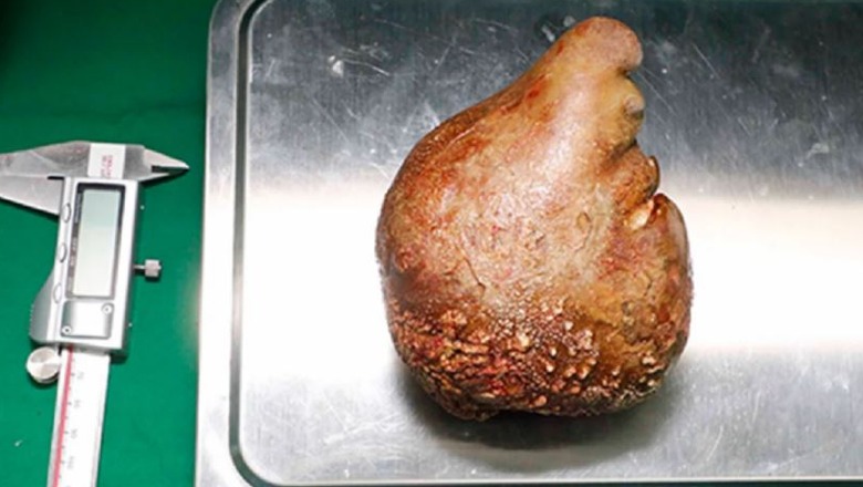 FOTOLAJM/ Rekord guinnes në Sri Lanka, pacientit i hiqet guri 13.4 cm nga veshkat 