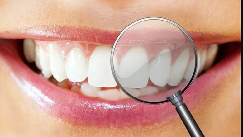 Tre shkaqet më të zakonshme që sjellin shfaqjen e njollave të bardha në dhëmbë