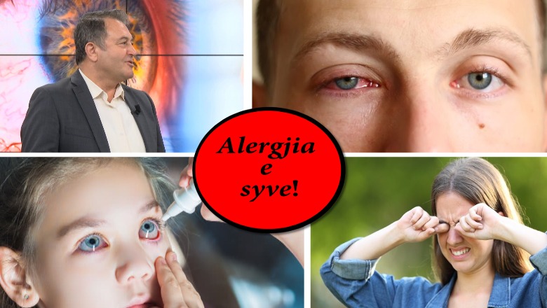Kurat popullore për alergjitë e syve / Ylli Merja tregon 'sekretin'... ja si të shpëtoni në pak ditë