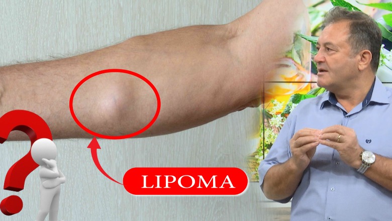 Gjëndër dhjamore apo tumor? Kur duhet të shqetësohemi… Çfarë janë lipomat dhe si mund t'i trajtojmë pa bisturi