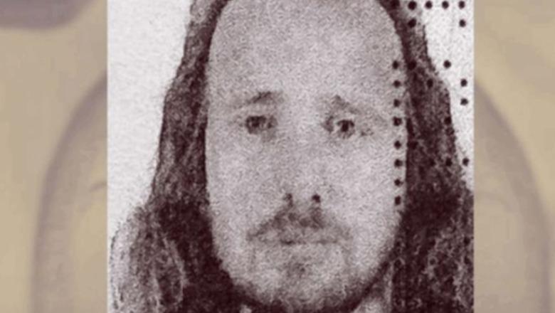 Turqi/ Pas transplantit të flokëve iu nënshtrua edhe një procedure dentare, ndërron jetë 36-vjeçari shqiptar