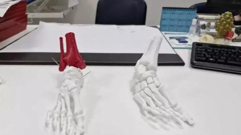 Historia e Besjanës, si arriti të ecë 27- vjeçarja shqiptare pas 10 vitesh operacione në Itali