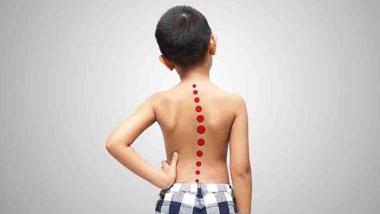 Skolioza tek fëmijët, mbi 700 raste në Shqipëri kërkojnë ndjekje të specializuar, Ministria e Shëndetësisë: Parandalimi nis me kontrollin e hershëm