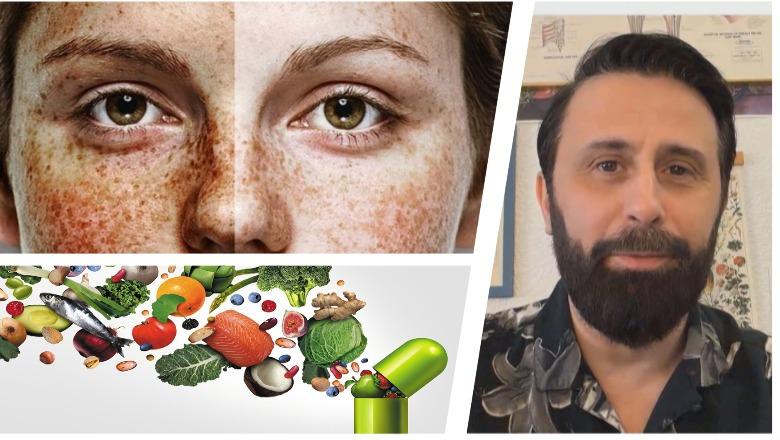 Njolla kafe në fytyrë, nuk është ‘faji’ i diellit, ja çfarë mungon në trupin tuaj! Sperma e mashkullit me një efekt të jashtëzakonshëm…